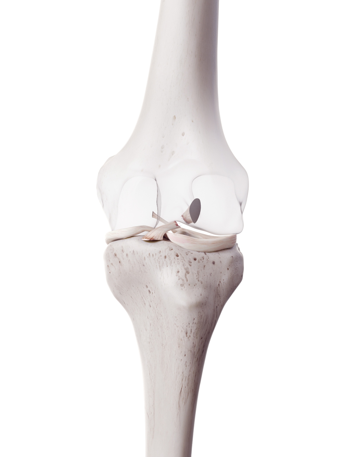 ACL Tear Orthopedic Centers of Colorado